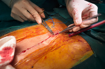 suture close sternotomy incision