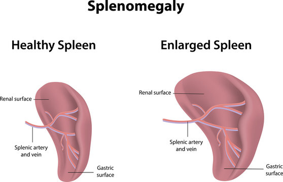 normal and enlarged spleen