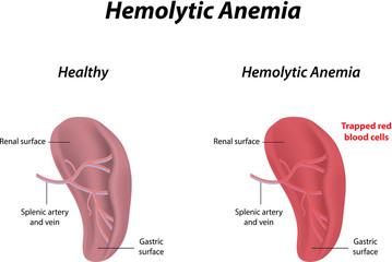 Hemolytic Anemia - obrazy, fototapety, plakaty