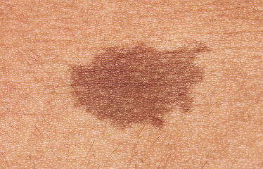 Close-up of brown birthmark