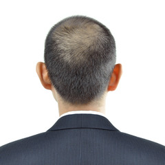 Hair thinning symptom on a man head