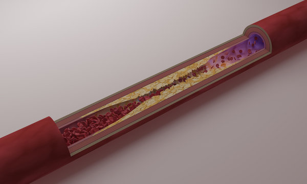 Arteriosklerose
