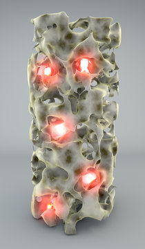 Sezione osso con osteoporosi 