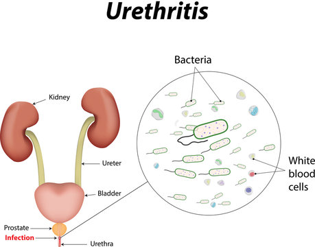 prostatitis urethritis antibiotikumok