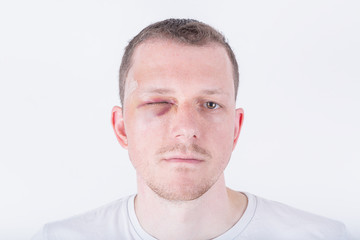 Obraz premium Patient mit blauem Auge