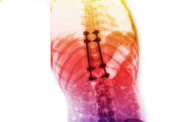 x-ray image of back pain  show spinal column with implant