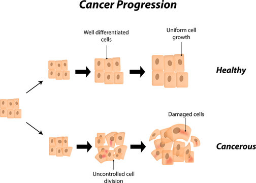 Cancer Progression