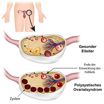 polycystic ovary syndrome, beschreibung deutsch