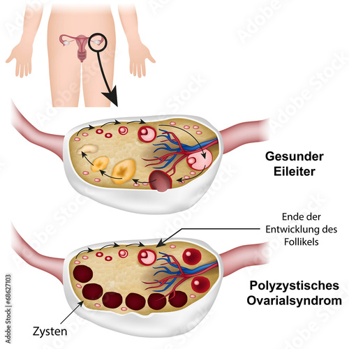 research paper on pcos Polycystic ovary syndrome (pcos) is of clinical and public health importance as it is very common, affecting up to one in five women of reproductive age it has significant and diverse clinical implications including reproductive (infertility, hyperandrogenism, hirsutism), metabolic (insulin resistance, impaired glucose tolerance, type 2. research paper on pcos Polycystic ovary syndrome (pcos) is of clinical and public health importance as it is very common, affecting up to one in five women of reproductive age it has significant and diverse clinical implications including reproductive (infertility, hyperandrogenism, hirsutism), metabolic (insulin resistance, impaired glucose tolerance, type 2.