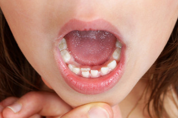 Kid with double row of teeth - 68657350