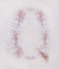 Scar letter Q on human skin