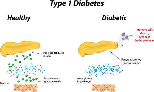 Type 1 Diabetes Labeled Diagram