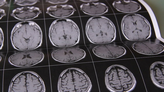 Mehrere Seiten mit MRI Bilder werden hingelegt