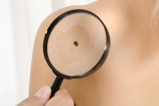 Arzt mit Verdacht auf Hautkrebs