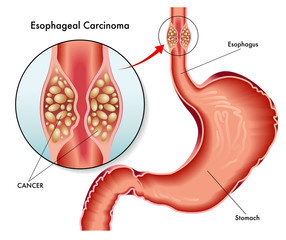 carcinoma esofageo
