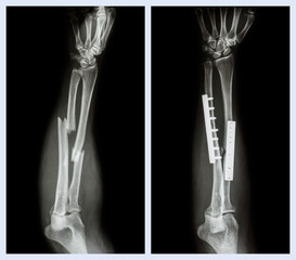Fracture both bone of forearm. It was operated,internal fixed