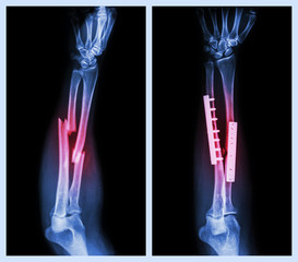 Fracture both bone of forearm. It was operated,internal fixed