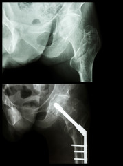 Intertrochanteric fracture left femur (fracture thigh's bone)