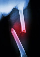 fracture shaft of femur(left thigh) and displace