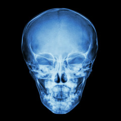 Fototapeta na wymiar normal thai child's skull