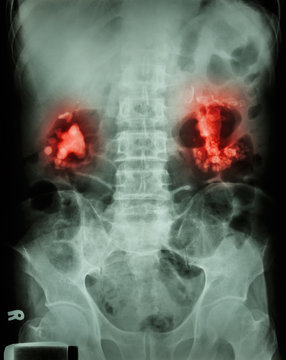 Bilateral renal calculi(staghorn) (Kidney stones)