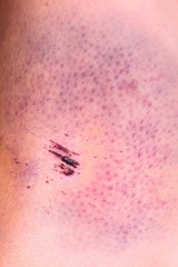 large hematoma on human arm