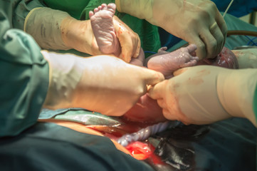 Operation for cesarean section with new born infant in operating