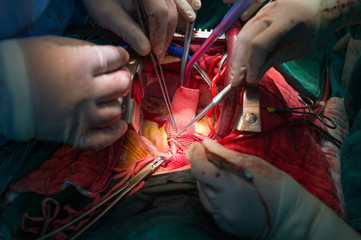 coronary re implantation in ascending aortic aneurysm