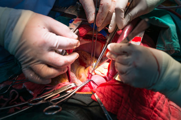 coronary re implantation in ascending aortic aneurysm