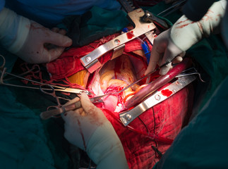 coronary re implantation in ascending aortic aneurysm
