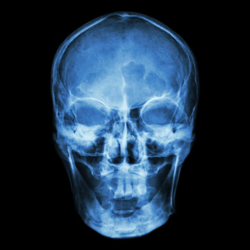 X-ray skull (Asian)