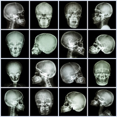 Collection x-ray skull (asian people)