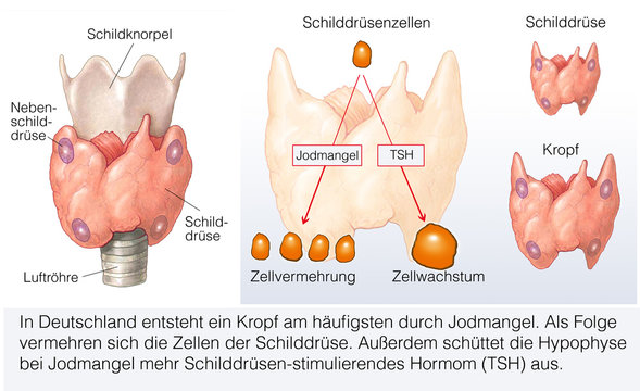 Schilddr&uuml;sen-Kropf
