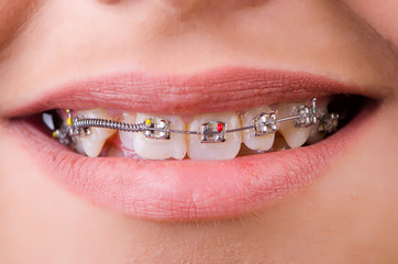 Mouth with brackets braces in medical concept