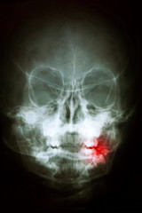 Panoramic dental X-Ray, with red painful area