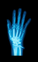 X-Ray image of human hands