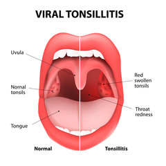 viral tonsillitis