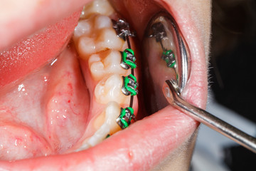 Obraz premium Teeth with braces