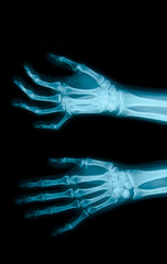 Film X-ray show bones