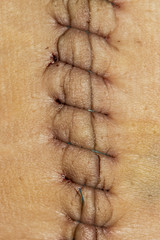 suture macro