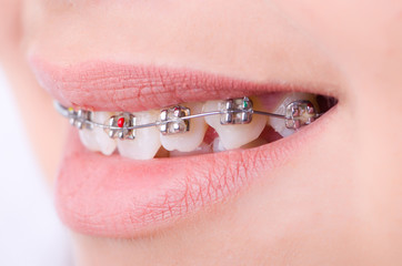 Fototapeta premium Mouth with brackets braces in medical concept