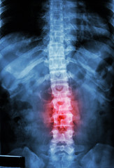 human's thoracic-lumbar spine and inflammation at lumbar spine