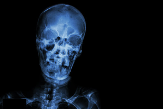 Film X-ray skull and blank area at right side