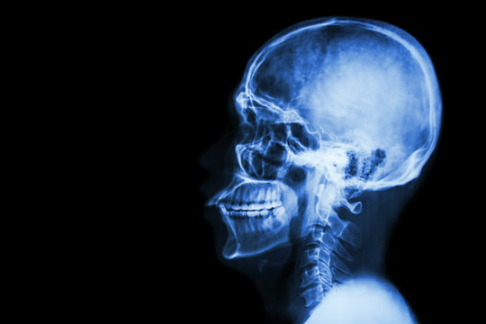 X-ray asian skull and blank area at left side