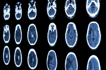 CT scan of brain show ischemic stroke and hemorrhagic stroke