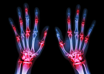 arthritis at multiple joint of hands (Gout,Rheumatoid)