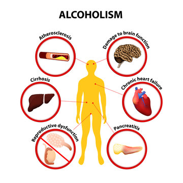 Alcoholism. infographic