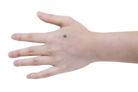 close up image  of mole on woman hand