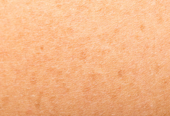 freckles on human skin