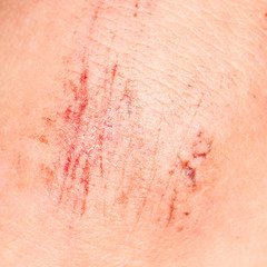 wound on the skin. close-up